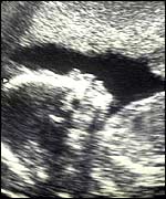 Pre-natal scan of baby