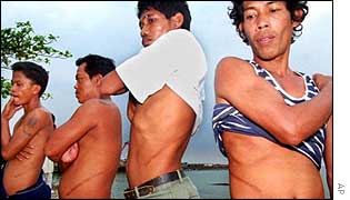 Philippine men display scars from selling their kidneys
