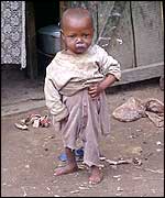 Malnourished child in Madagascar