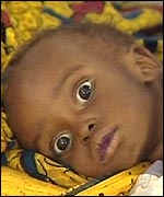 Malnourished child in Malawi