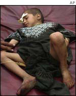 Child injured in the bombing