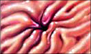 Stomach ulcer