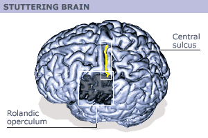 Image - areas of left brain altered in stuttering brain