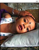 An Indian girl suffering encephalitis, which is transmitted by mosquitoes