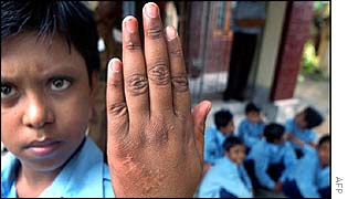 Former jockey Nuru Mia, 10, shows camel bites on his hand