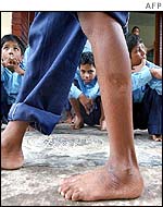Mohammad Mamun, 10, shows his injured leg