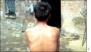Aids sufferer Yu Daguan shows the lesions on his back, symptoms of the disease