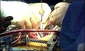 Heart surgery