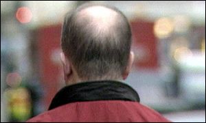 Male pattern baldness could be helped, it is claimed