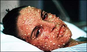 An actress is made up to show the disfiguring effects of smallpox