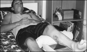 Photo of the full-thickness burns