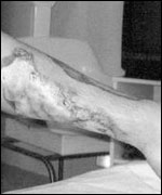 Photograph of the boy's burns