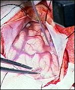 Brain surgery
