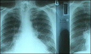 Chest x-ray