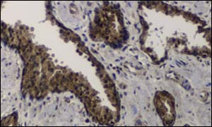 Prostate cancer cells under the microscope