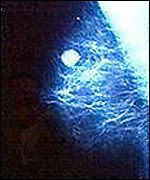 Breast tumour