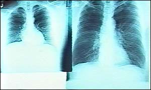 lung x-rays