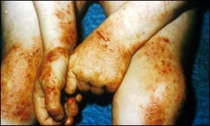 Child with eczema