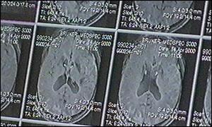 Brain scans