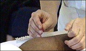 Acupuncture