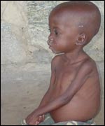 Malnourished child in Lira Starch factory camp