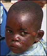 Five-year-old Herbert Chikasa, with head injuries