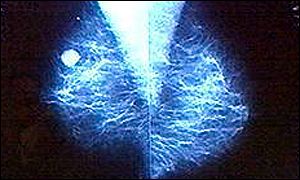 Breast tumour on x-ray