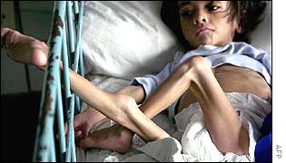 Starving Argentine child