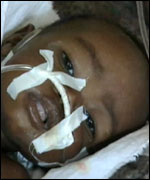 Child at Cumbila makeshift clinic 