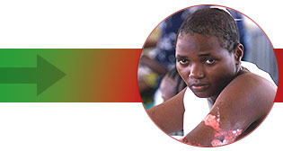 Jane, hotel receptionist, sits in a Mombasa hospital after she received severe burns in the Paradise hotel bombing