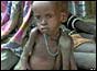 Panhien Garang, a one and half year-old-malnourished child sits at a feeding point in Pakot, southern Sudan