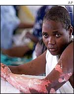 Former receptionist, Jane, with a burned arm in Mombasa hospital