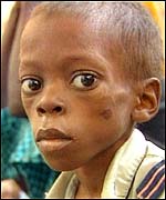 A starving Ethiopian child