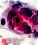 Breast cancer cells under microscope