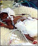 Premature baby