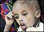 starving Ethiopian child