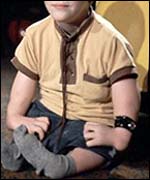 Thalidomide-affected boy