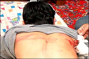 Student shows knife wounds on back