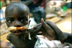 A malnourished boy with a feeding tube into his nose at a hospital in the northern Ugandan town of Gulu