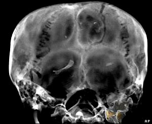 X-ray image of Tutankhamun's head