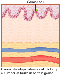 Cancer develops when a cell picks up a number of faults in certain genes
