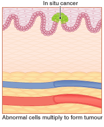 Abnormal cells multiply to form a tumour