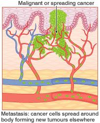 Metastasis: cancer cells speread around the body forming new tumours elsewhere