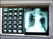 د نري رنځ کتنه