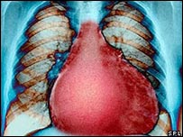 बढ़ा हुआ दिल