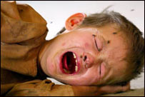 طفل مبتلا به اسهال 