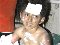 دھماکے میں زخمی بچے