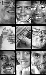 Faces of people with vitiligo