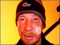 Conrad with frost nip