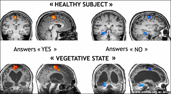  Brain scan results of a recent study on brain activity in disorders of consciousness.